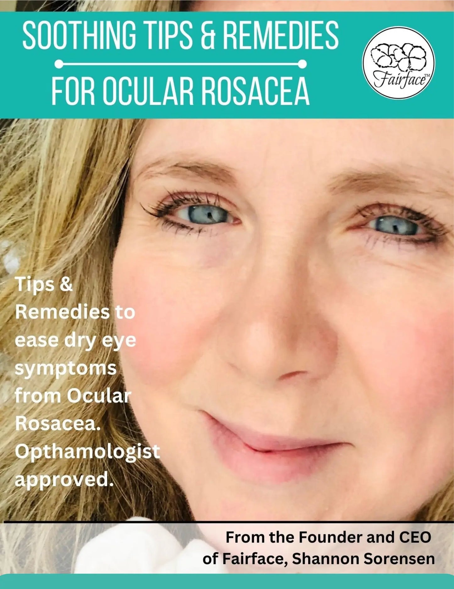 Ocular Rosacea | Dry Eyes Help | Ocular Rosacea Tips | Digital Guide - magnet-innov